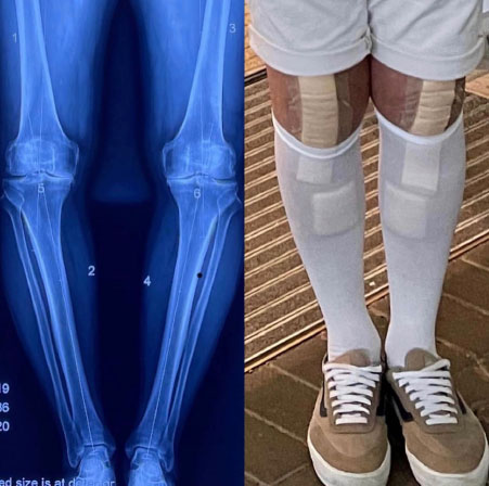 X-ray of bow knees next to photo of patient after bilteral knee replacement showing surgery has resulted in 'straighter' legs