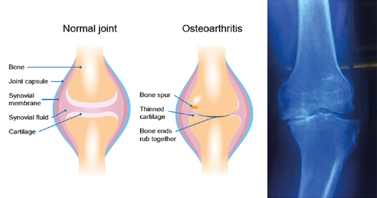 Osteoarthritis (also known as OA) is a common joint disease that most often affects middle-age to elderly people. 
