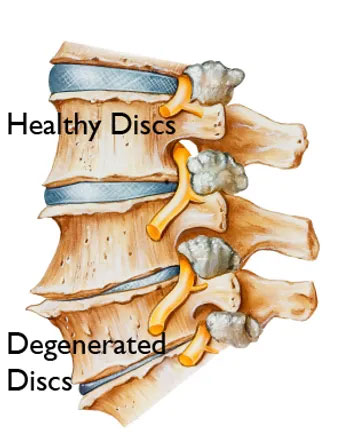 Healthy disc vs degenerated disc