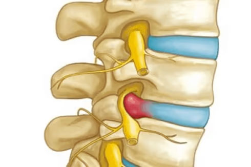 Herniated disc