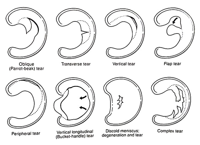 Diagram of the different types of meniscal tears that can occur in the knee