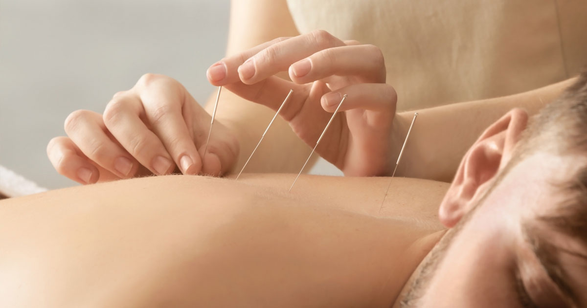 Dry needling and acupuncture involve the insertion of thin needles into certain parts of the body, but the similarities stop there. 