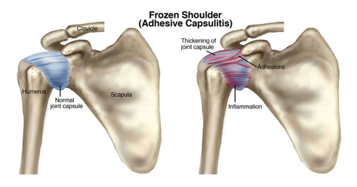 A frozen shoulder follows a relatively predictable course that involves three stages and usually resolves within 12-24 months.  