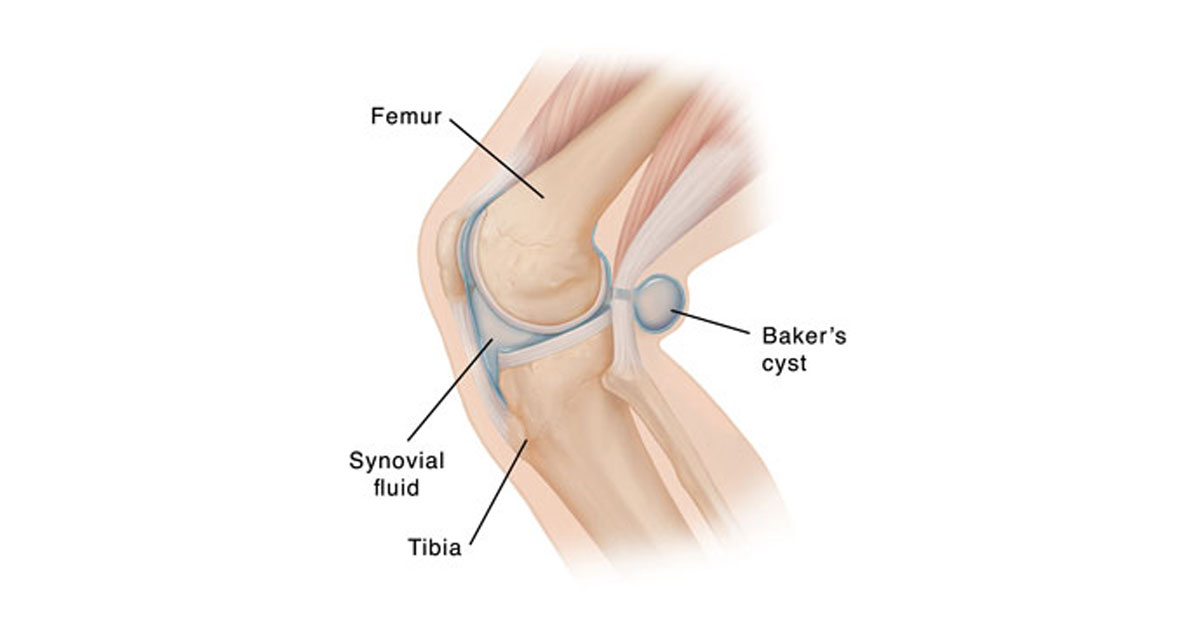 When your knee produces too much synovial fluid, the excess fluid causes the bursa behind the knee to expand and bulge and is called a Bakers Cyst. 