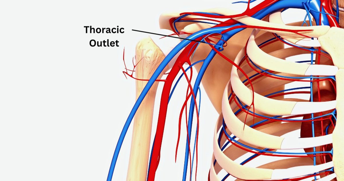 Thoracic outlet syndrome (TOS) is a condition characterized by compression of the nerves and blood vessels that pass through the thoracic outlet, a narrow passageway between the base of the neck and the armpit.