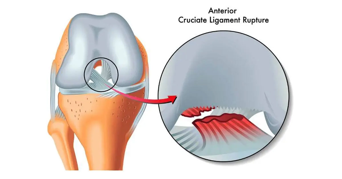 Treatment for ACL injuries has evolved significantly over the years, with a focus on evidence-based approaches to optimize outcomes.