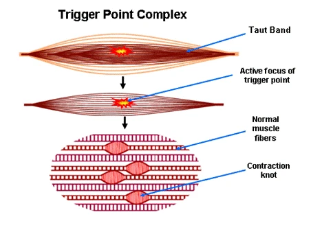 Illustration showing trigger point complex: taut band, active focus of trigger point, normal muscles fibres and contraction knots
