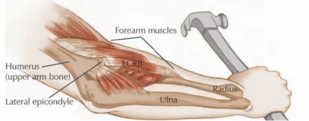 Medical illustration showing the anatomy of the muscles, bones and tendons of the elbow.