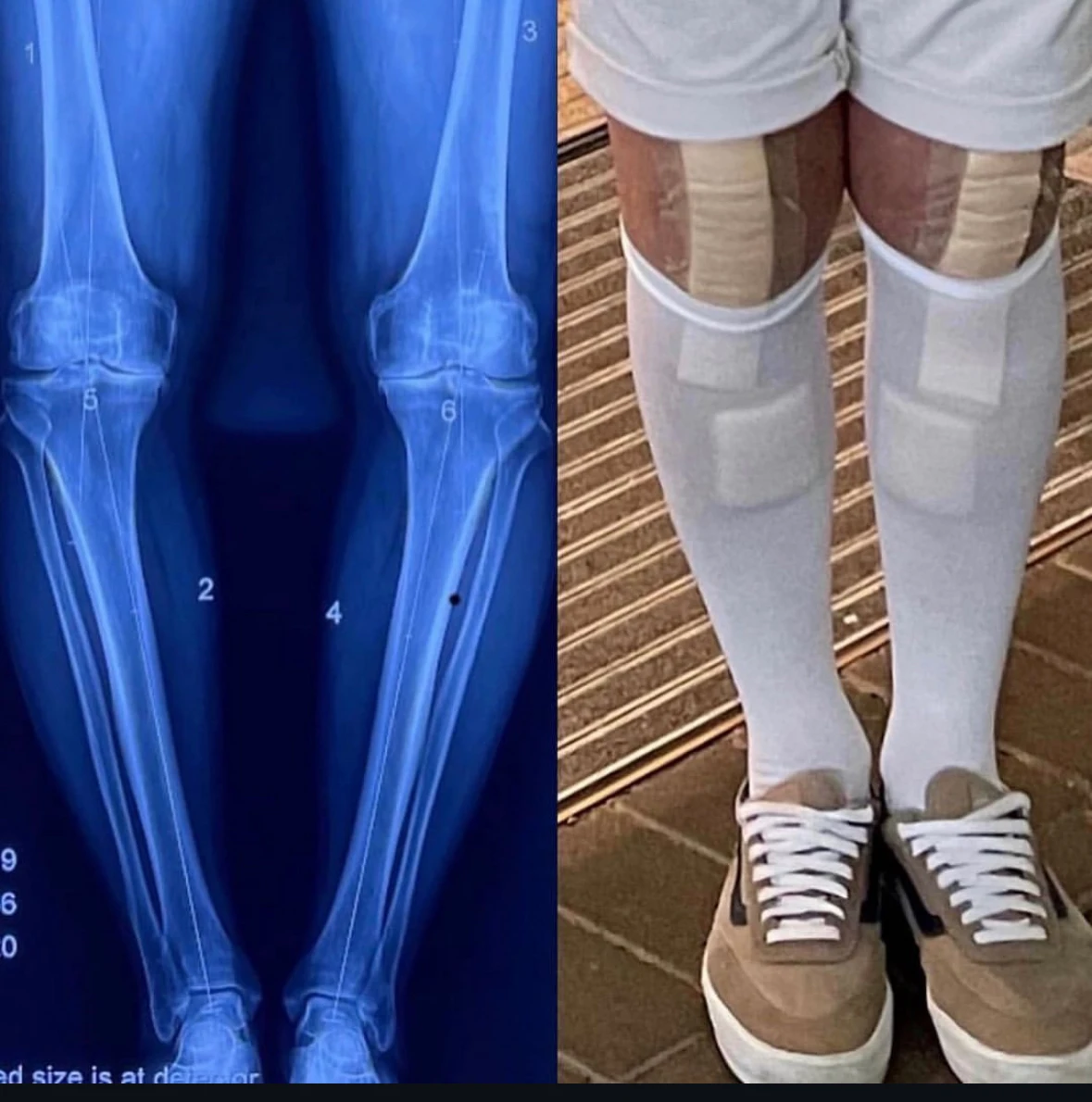 Patient at Sports and Spine Physiotherapy in Brookvale - Northern Beaches undertaking post surgery rehab after knee surgery